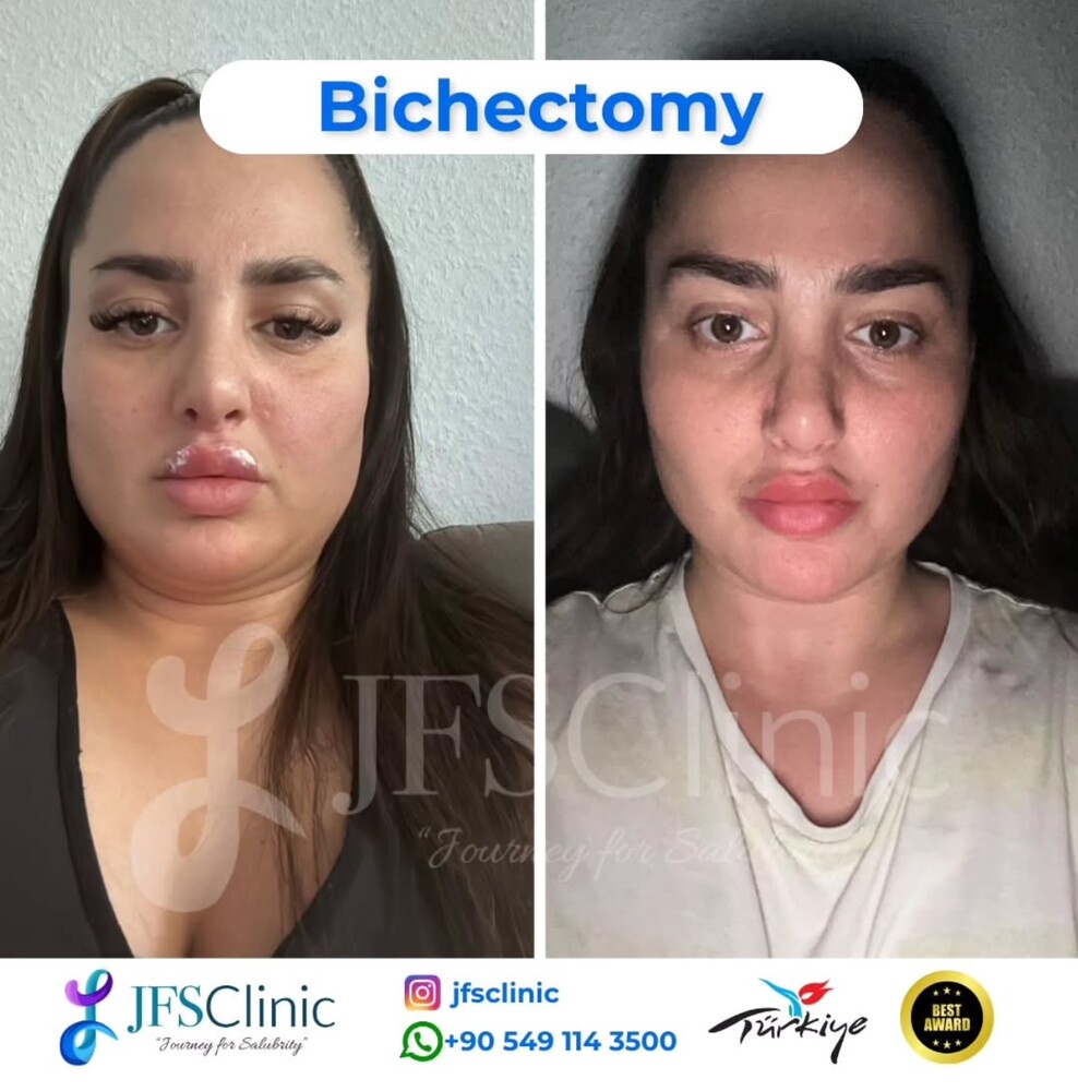 Before and After Result